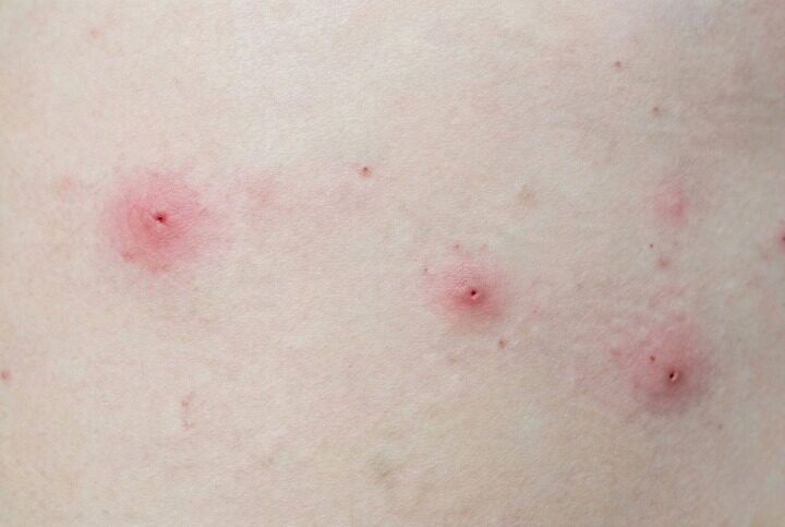 ダニ刺され画像